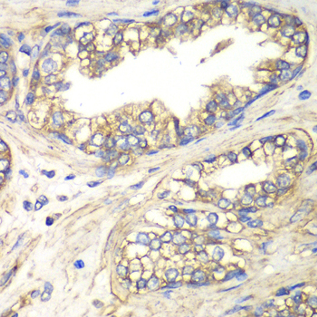 Immunohistochemistry of paraffin-embedded human prostate using SLC4A4 / NBC antibody (19-594) at dilution of 1:100 (40x lens) .