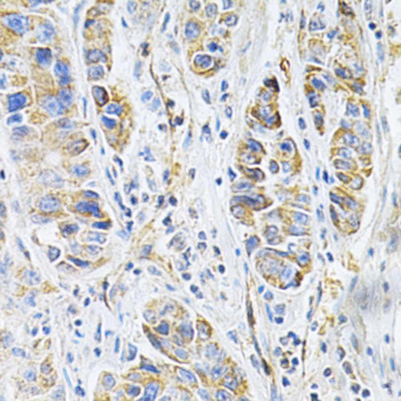 Immunohistochemistry of paraffin-embedded human liver cancer using VAPB Antibody (19-617) at dilution of 1:200 (40x lens) .