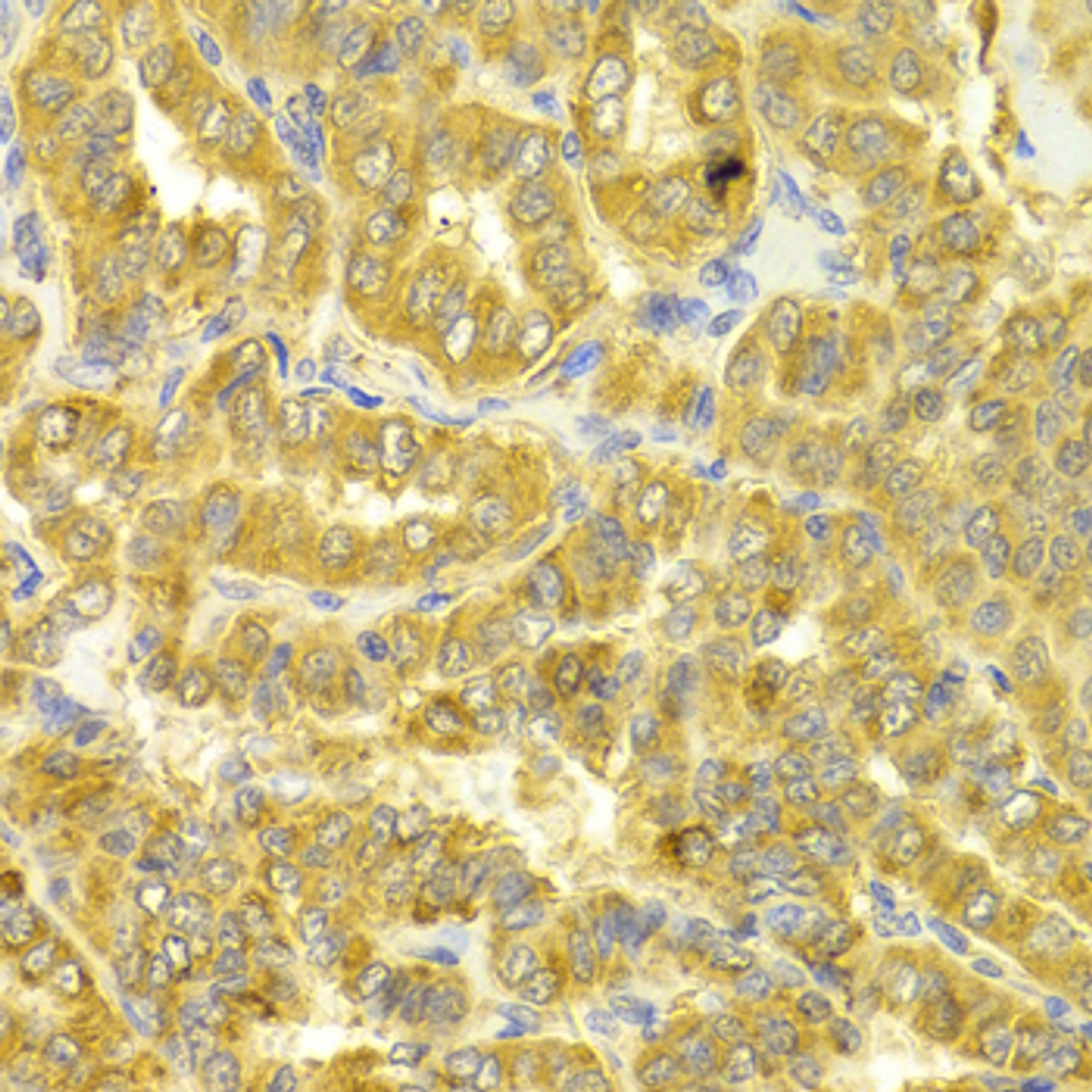 Immunohistochemistry of paraffin-embedded human thyroid cancer using DLD Antibody (19-643) at dilution of 1:100 (40x lens) .