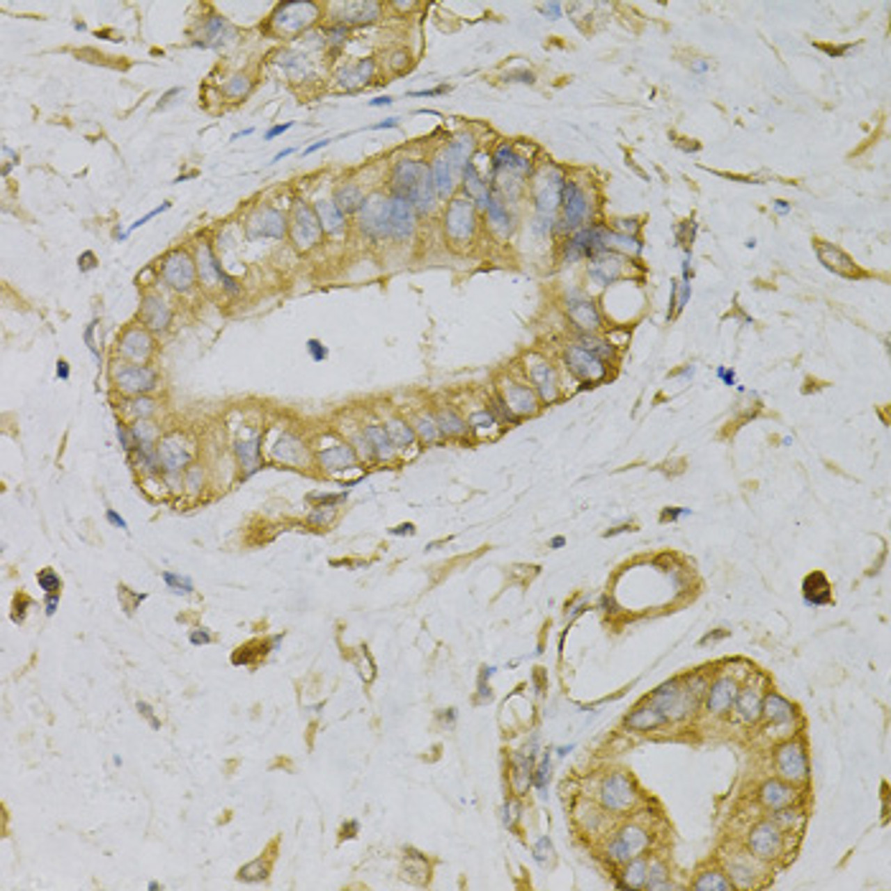 Immunohistochemistry of paraffin-embedded human liver cancer using EIF4B Antibody (19-645) at dilution of 1:100 (40x lens) .