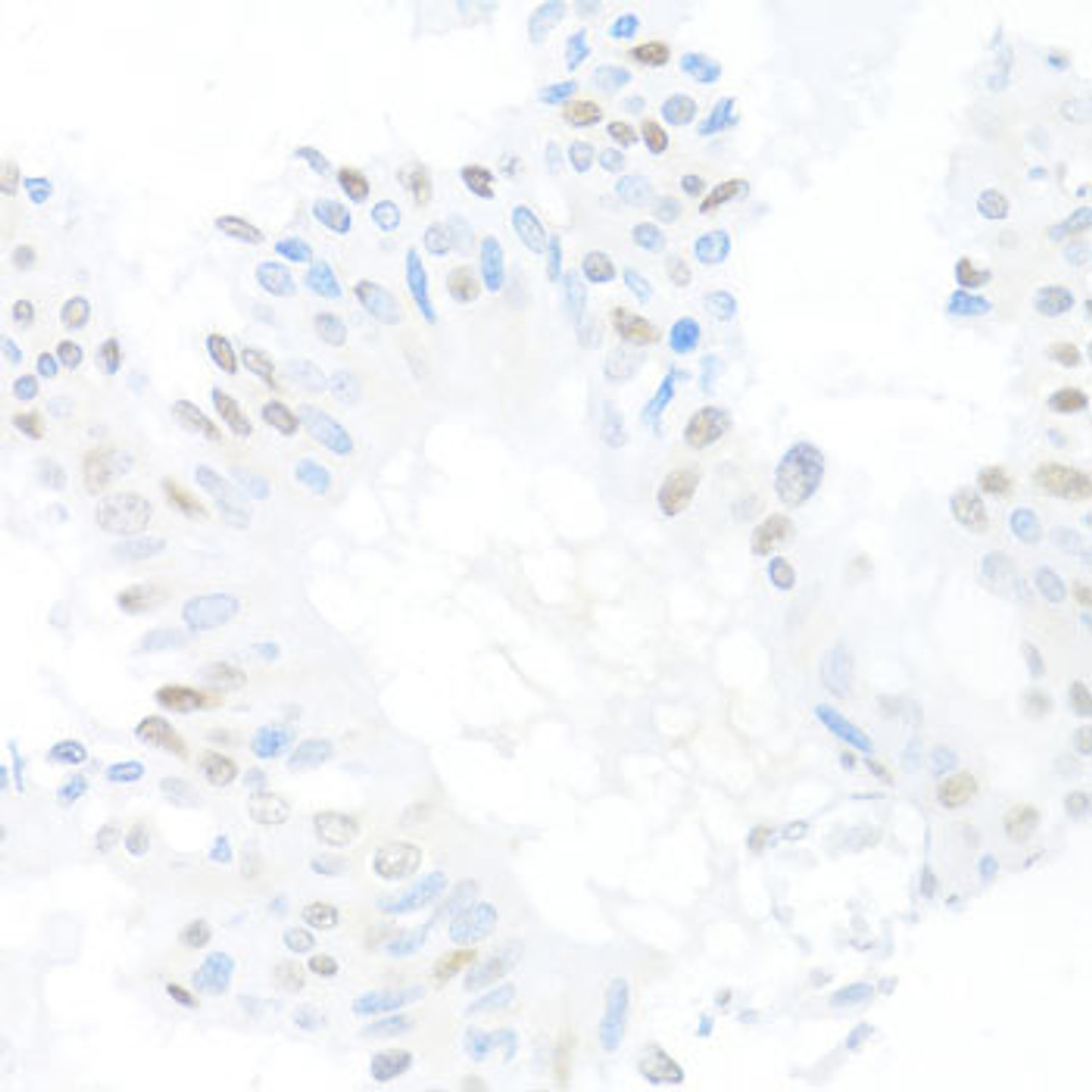 Immunohistochemistry of paraffin-embedded human mammary cancer using CREM antibody (19-762) at dilution of 1:100 (40x lens) .