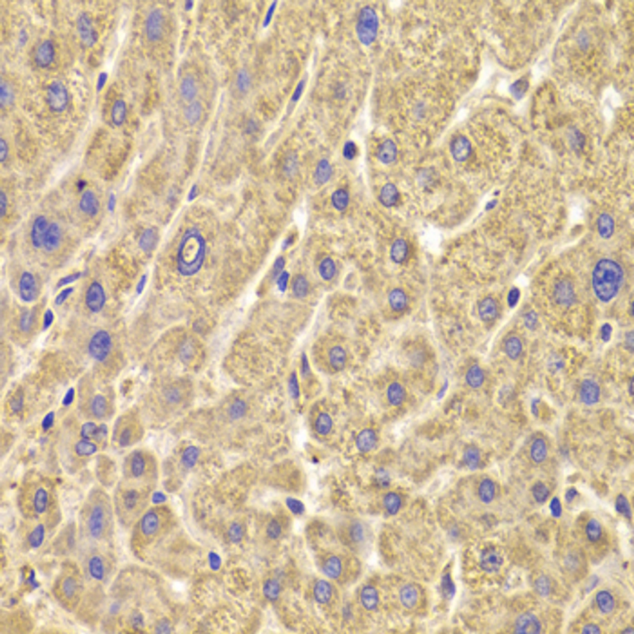 Immunohistochemistry of paraffin-embedded human liver damage using PEX5 antibody (19-855) at dilution of 1:100 (40x lens) .