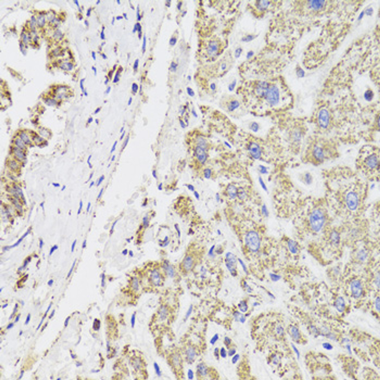 Immunohistochemistry of paraffin-embedded human liver damage using MDH2 Antibody (22-108) at dilution of 1:100 (40x lens) .