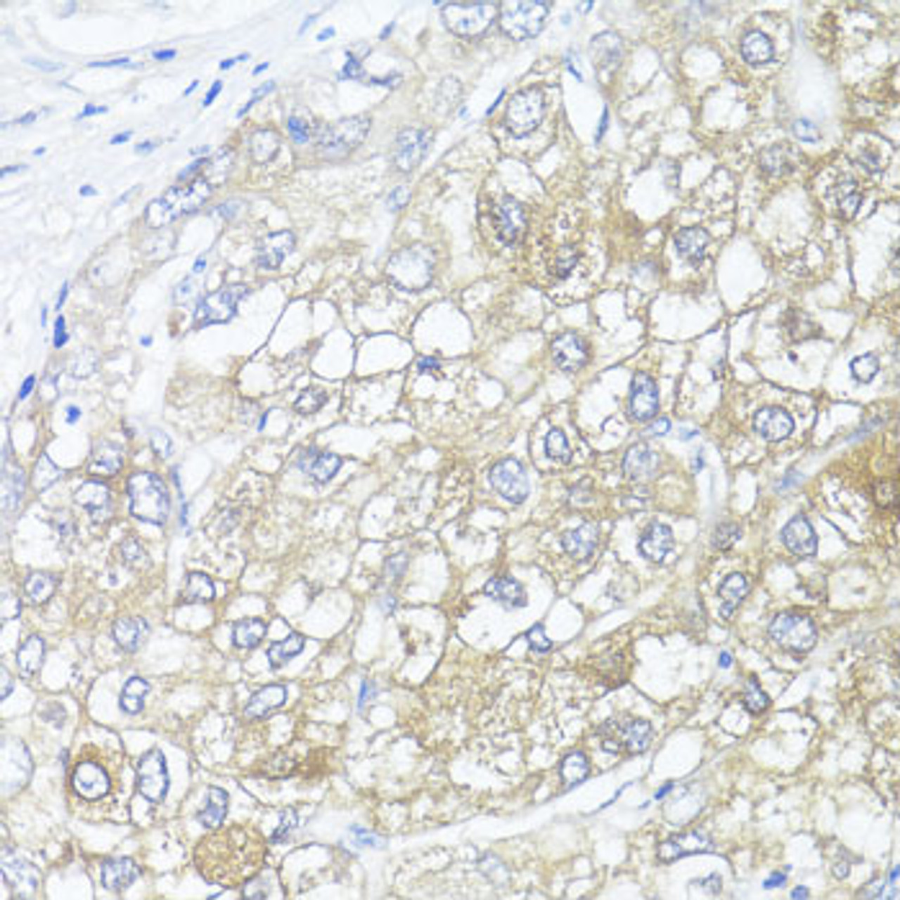 Immunohistochemistry of paraffin-embedded human liver cancer using ASL antibody (22-154) at dilution of 1:100 (40x lens) .