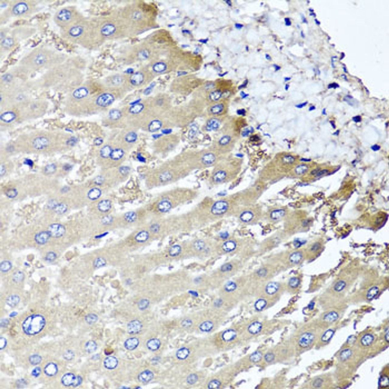 Immunohistochemistry of paraffin-embedded human liver damage using MGAT1 antibody (22-178) at dilution of 1:100 (40x lens) .