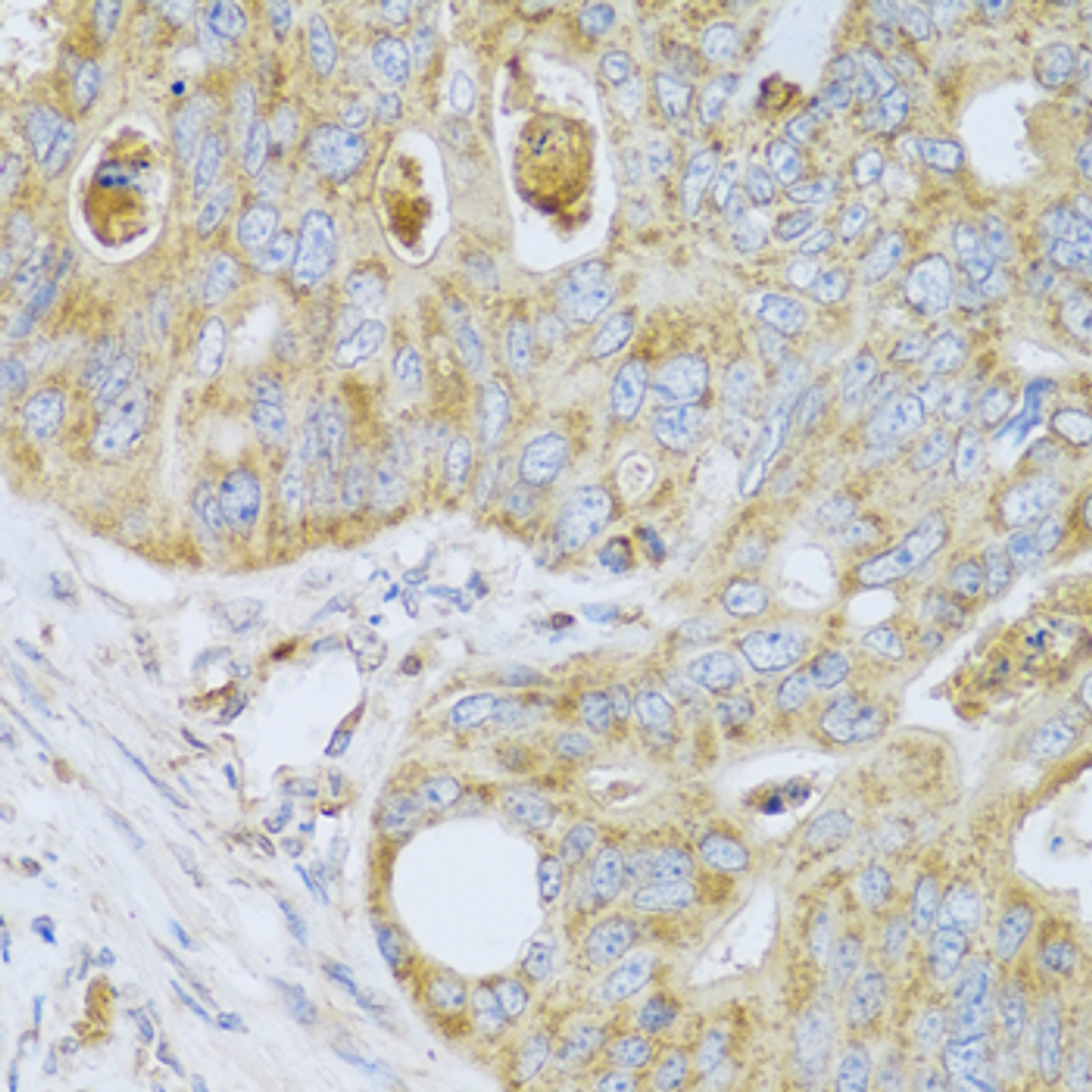 Immunohistochemistry of paraffin-embedded human colon carcinoma using PSG1 antibody (22-189) at dilution of 1:100 (40x lens) .