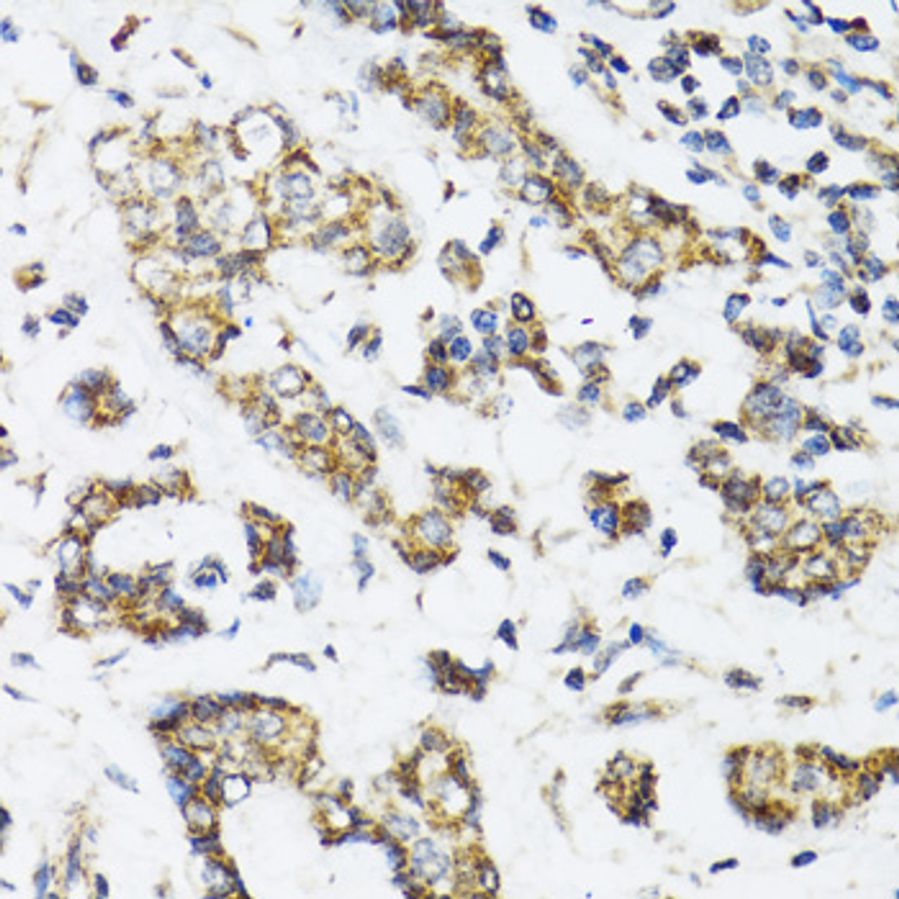 Immunohistochemistry of paraffin-embedded human breast cancer using DHRS2 antibody (22-229) at dilution of 1:100 (40x lens) .