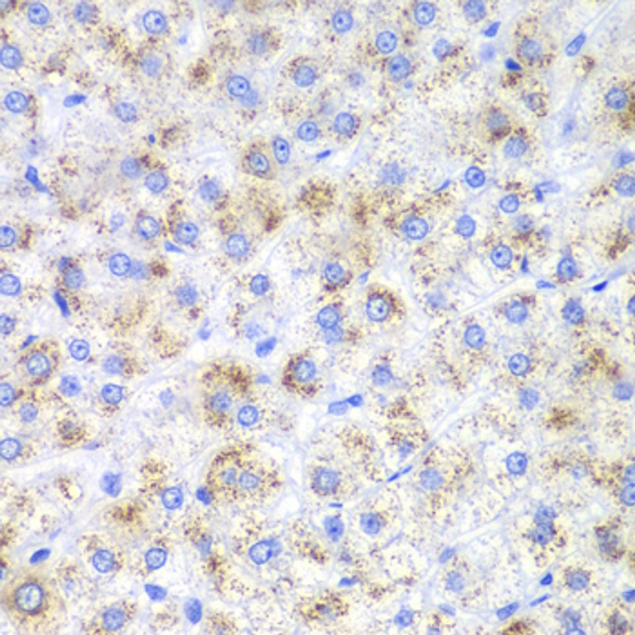 Immunohistochemistry of paraffin-embedded human liver cancer using HAO1 antibody (22-249) at dilution of 1:200 (40x lens) .