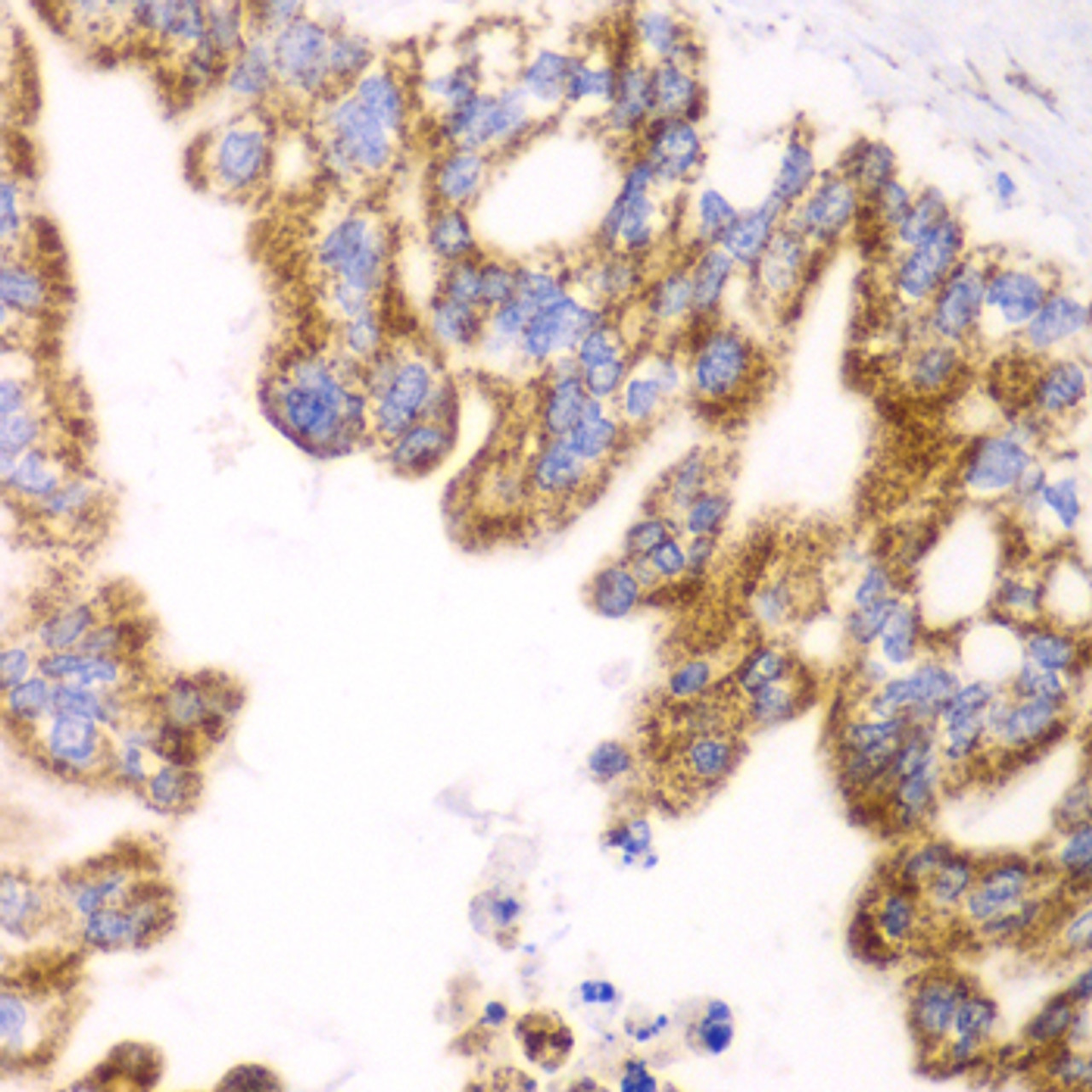 Immunohistochemistry of paraffin-embedded human liver cancer using GLUD2 antibody (22-344) at dilution of 1:100 (40x lens) .