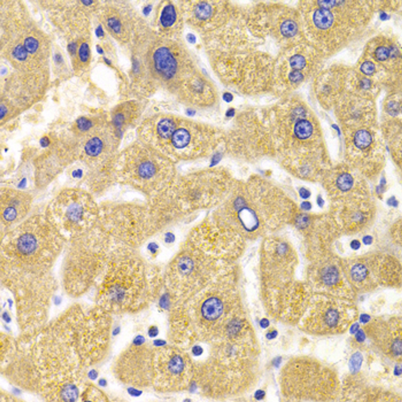 Immunohistochemistry of paraffin-embedded human liver damage using KIF1B Antibody (22-371) at dilution of 1:100 (40x lens) .