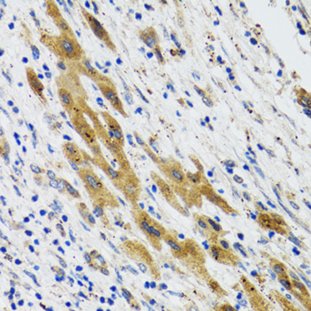 Immunohistochemistry of paraffin-embedded human liver cancer using PLA2G2D antibody (22-408) at dilution of 1:100 (40x lens) .