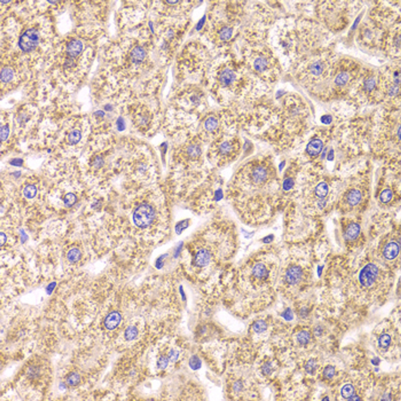 Immunohistochemistry of paraffin-embedded human liver damage using ST3GAL3 antibody (22-462) at dilution of 1:100 (40x lens) .