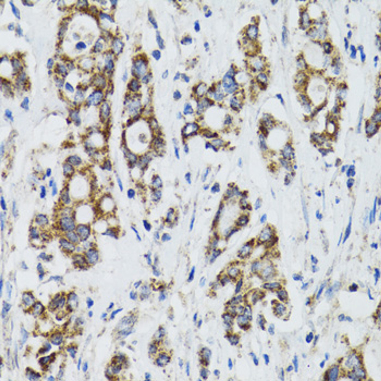 Immunohistochemistry of paraffin-embedded human colon carcinoma using SURF1 antibody (22-466) at dilution of 1:100 (40x lens) .