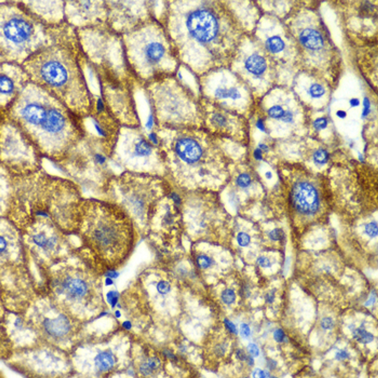 Immunohistochemistry of paraffin-embedded human liver damage using ASGR1 antibody (22-519) at dilution of 1:100 (40x lens) .