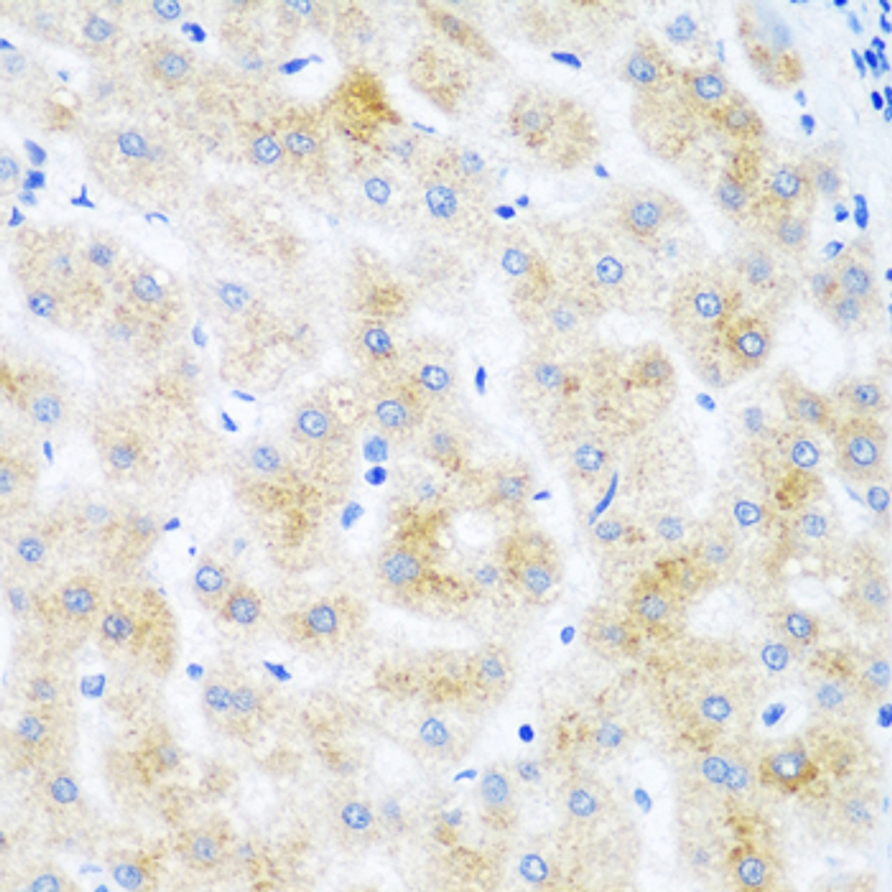Immunohistochemistry of paraffin-embedded human liver cancer using DHODH antibody (22-539) at dilution of 1:100 (40x lens) .