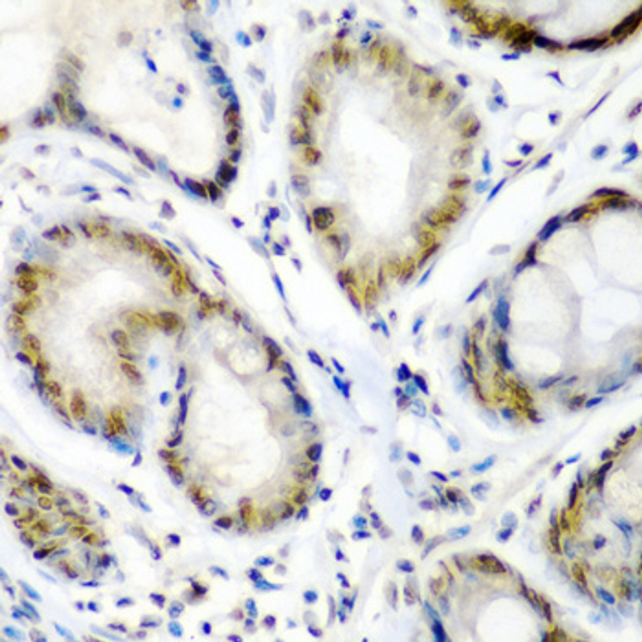 Immunohistochemistry of paraffin-embedded human colon carcinoma using SS18 antibody (22-612) at dilution of 1:200 (40x lens) .