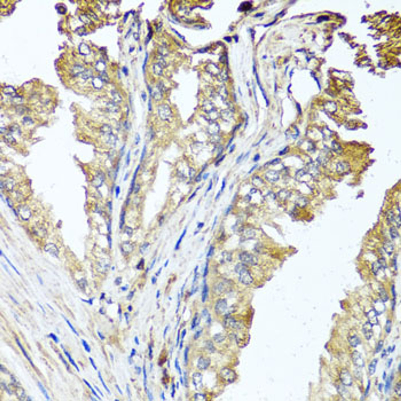 Immunohistochemistry of paraffin-embedded human prostate using STK3 antibody (22-614) at dilution of 1:100 (40x lens) .