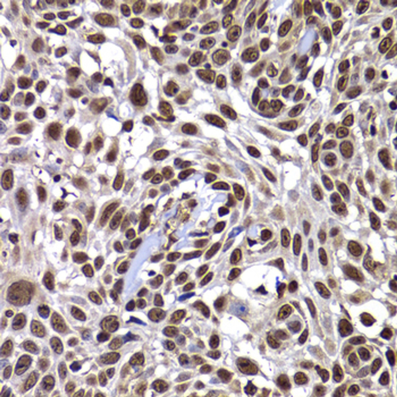 Immunohistochemistry of paraffin-embedded human well-differentiated squamous skin carcinoma using DNAJB6 antibody (22-660) at dilution of 1:100 (40x lens) .