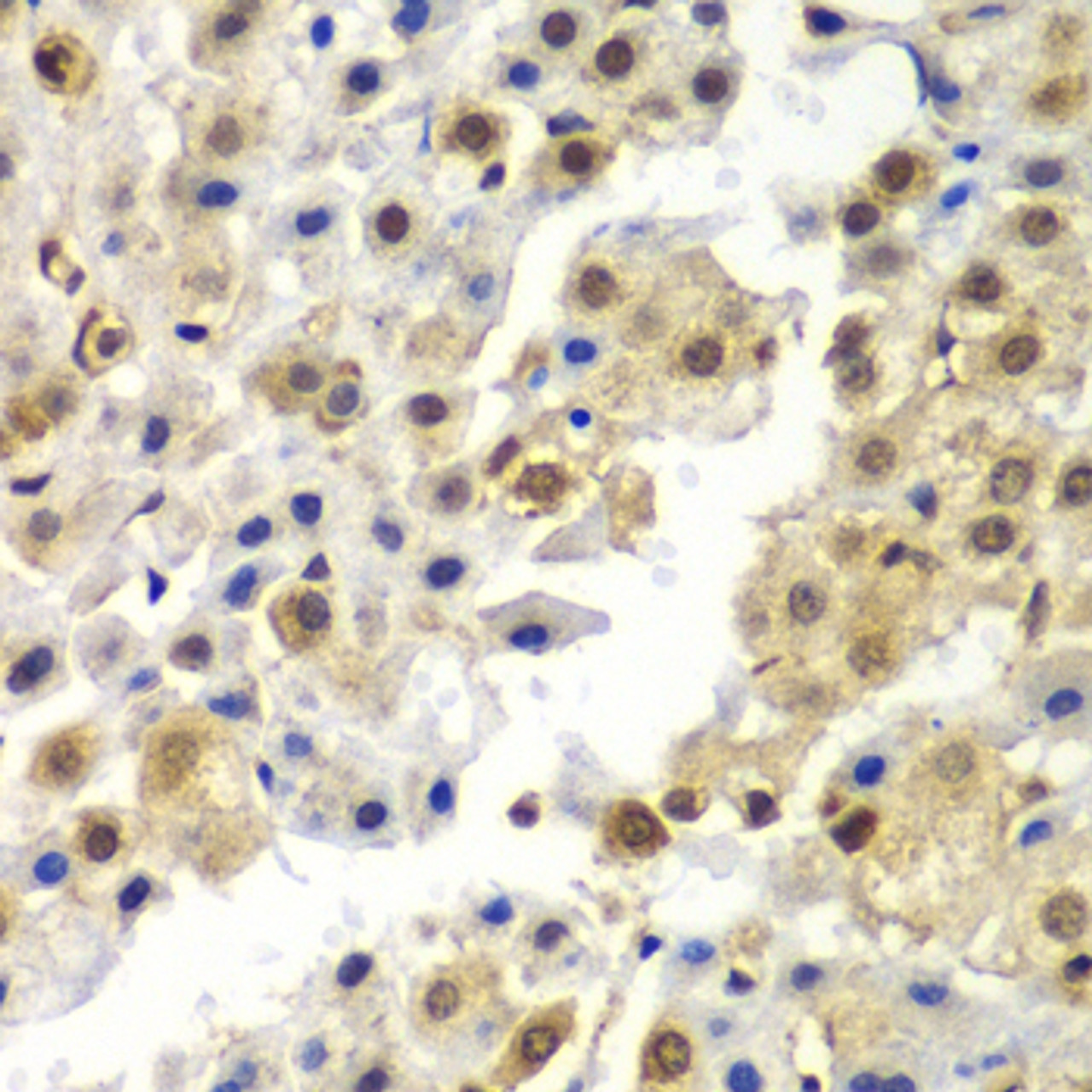 Immunohistochemistry of paraffin-embedded human liver cancer using SYNCRIP antibody (22-792) at dilution of 1:100 (40x lens) .