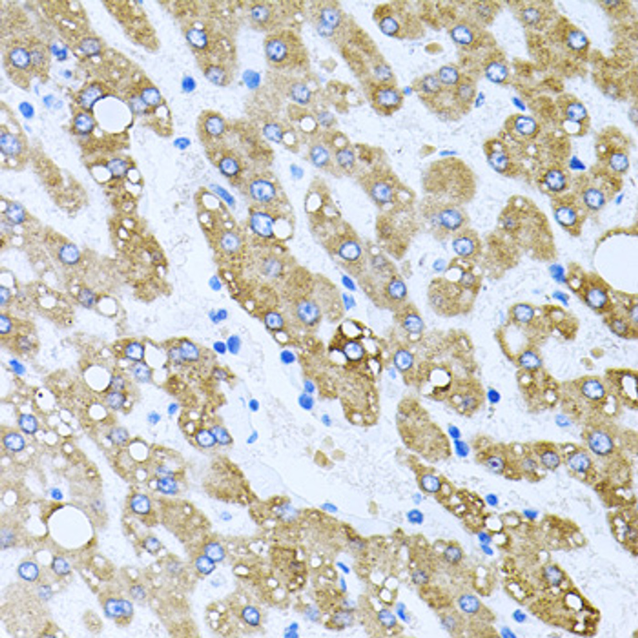 Immunohistochemistry of paraffin-embedded human liver damage using TOB2 antibody (22-795) at dilution of 1:100 (40x lens) .