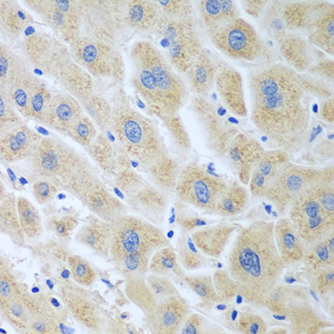 Immunohistochemistry of paraffin-embedded human liver cancer using BLVRB antibody (22-819) at dilution of 1:100 (40x lens) .