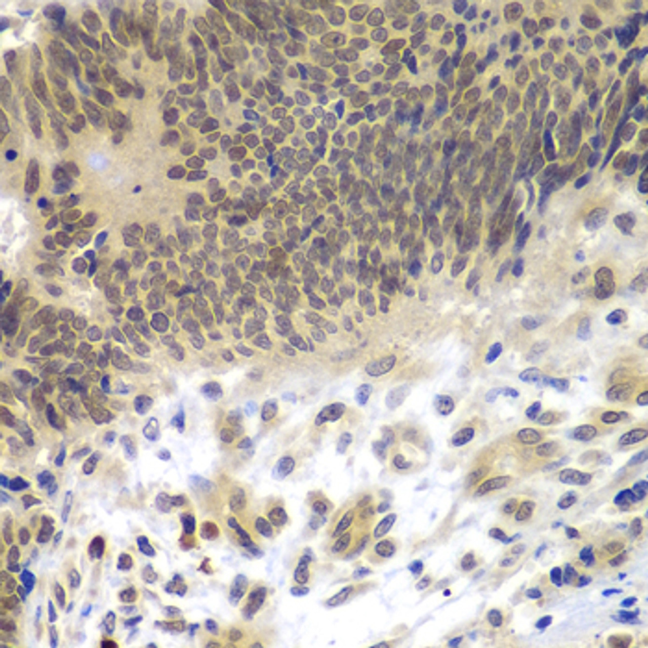 Immunohistochemistry of paraffin-embedded human colon carcinoma using CEBPG antibody (22-831) at dilution of 1:100 (40x lens) .