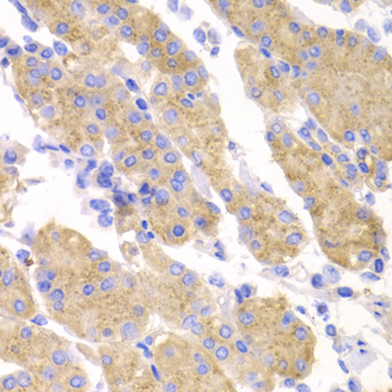 Immunohistochemistry of paraffin-embedded human gastric cancer using SMYD4 antibody (22-854) at dilution of 1:100 (40x lens) .