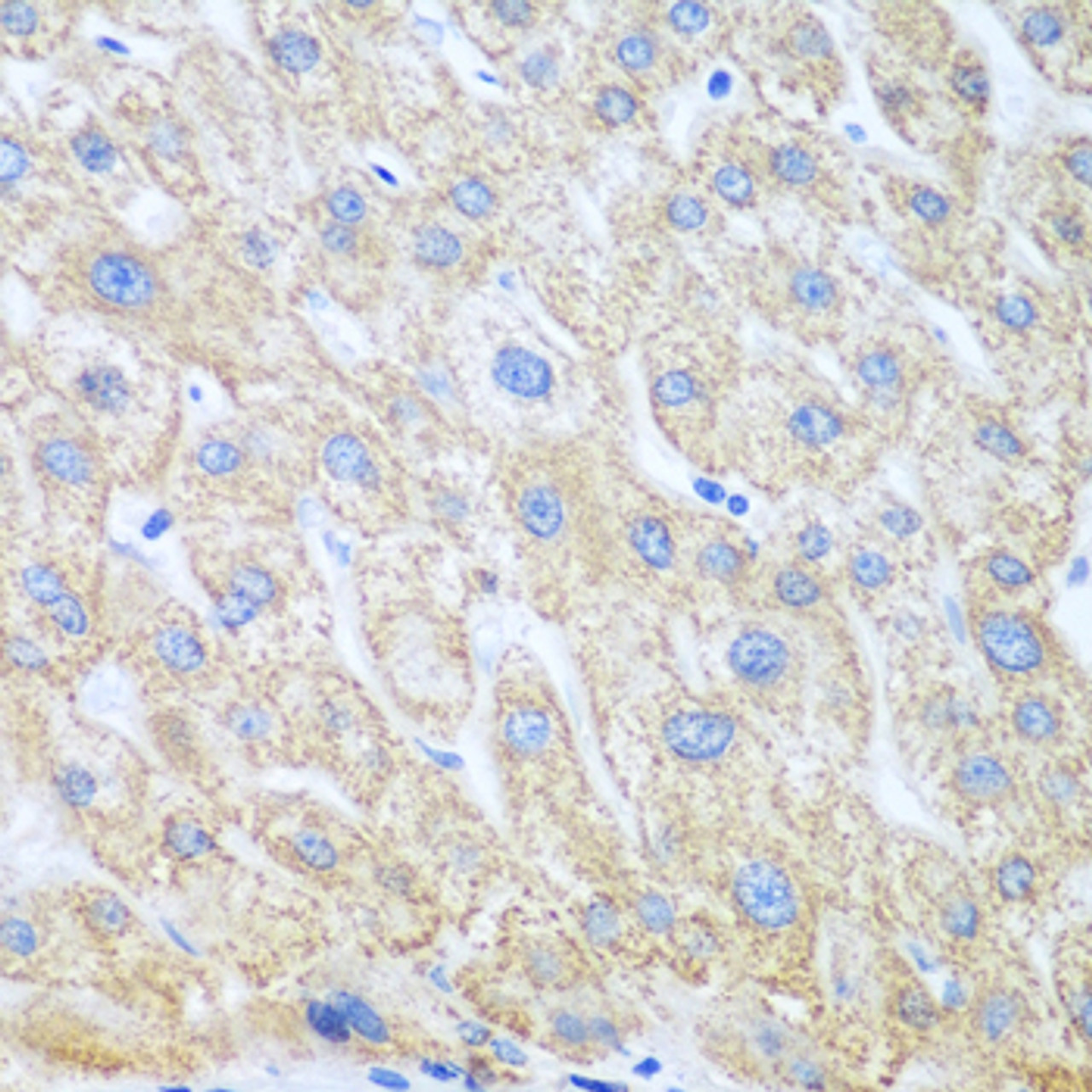 Immunohistochemistry of paraffin-embedded human liver cancer using PTGS1 antibody (22-876) at dilution of 1:100 (40x lens) .
