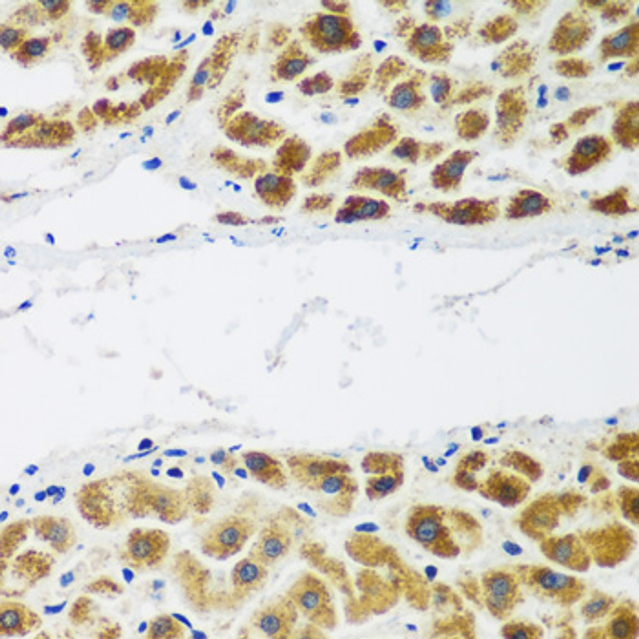 Immunohistochemistry of paraffin-embedded human liver cancer using NAA60 antibody (22-906) at dilution of 1:200 (40x lens) .