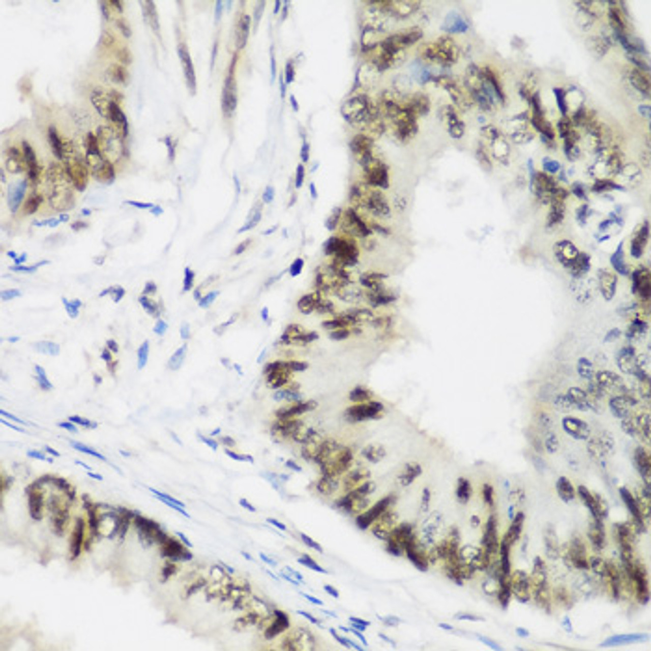 Immunohistochemistry of paraffin-embedded human colon carcinoma using AEBP2 antibody (22-914) at dilution of 1:200 (40x lens) .