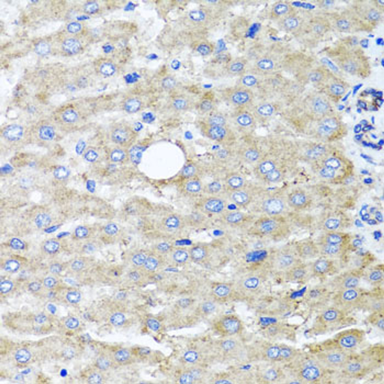 Immunohistochemistry of paraffin-embedded human liver damage using DFNA5 antibody (22-935) at dilution of 1:100 (40x lens) .