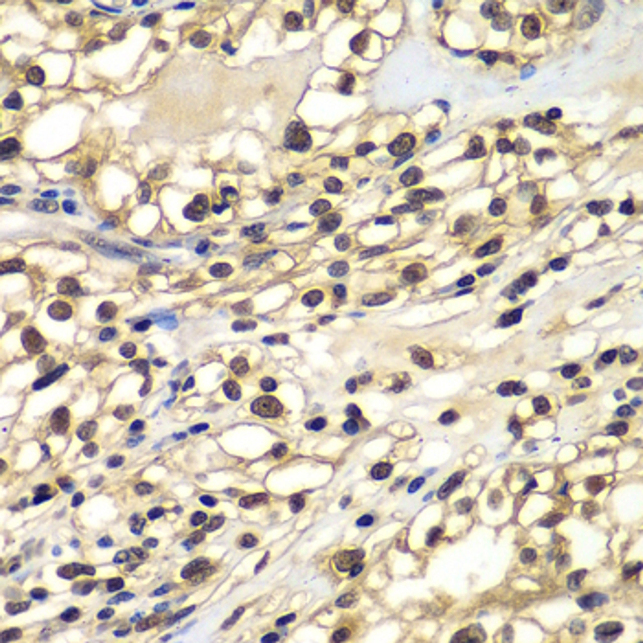 Immunohistochemistry of paraffin-embedded human kidney cancer using ZNF169 antibody (22-977) at dilution of 1:100 (40x lens) .