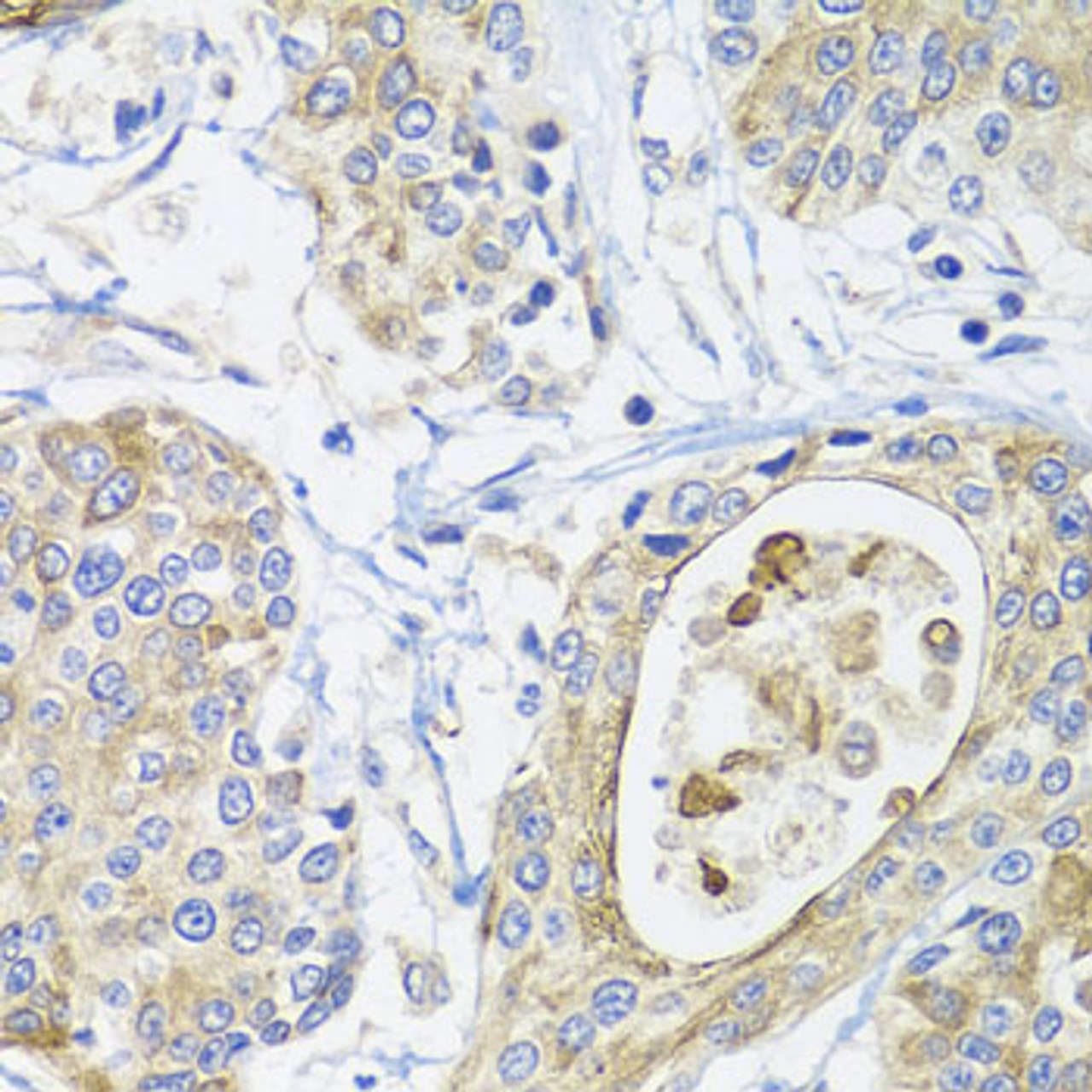 Immunohistochemistry of paraffin-embedded human prostate cancer using GSTA2 antibody (23-102) at dilution of 1:100 (40x lens) .