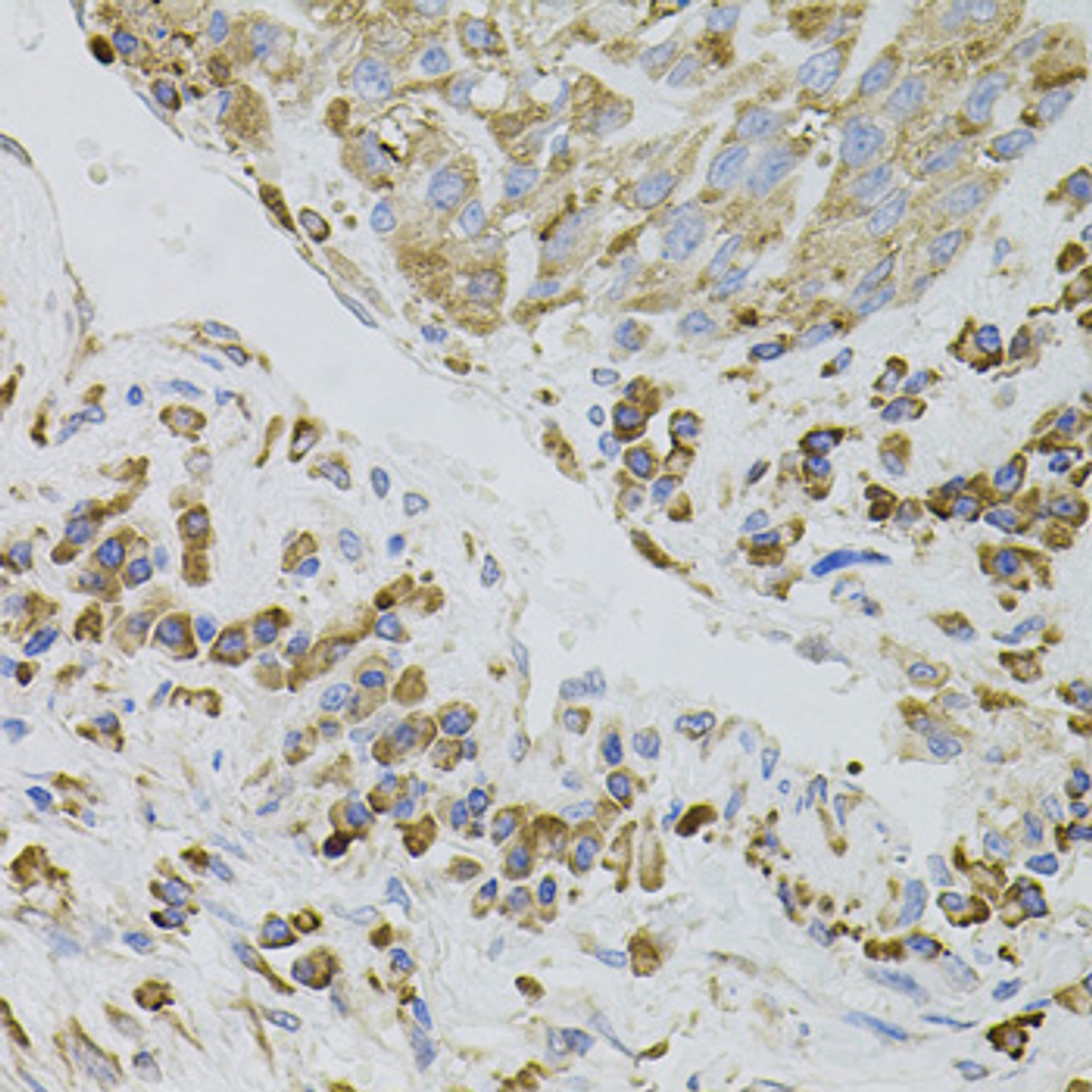 Immunohistochemistry of paraffin-embedded human lung cancer using IRF1 antibody (23-112) (40x lens) .