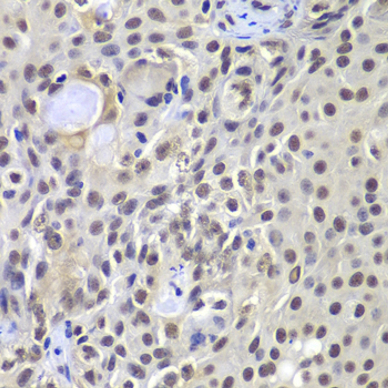 Immunohistochemistry of paraffin-embedded human well-differentiated squamous skin carcinoma using PRKDC antibody (23-125) at dilution of 1:100 (40x lens) .