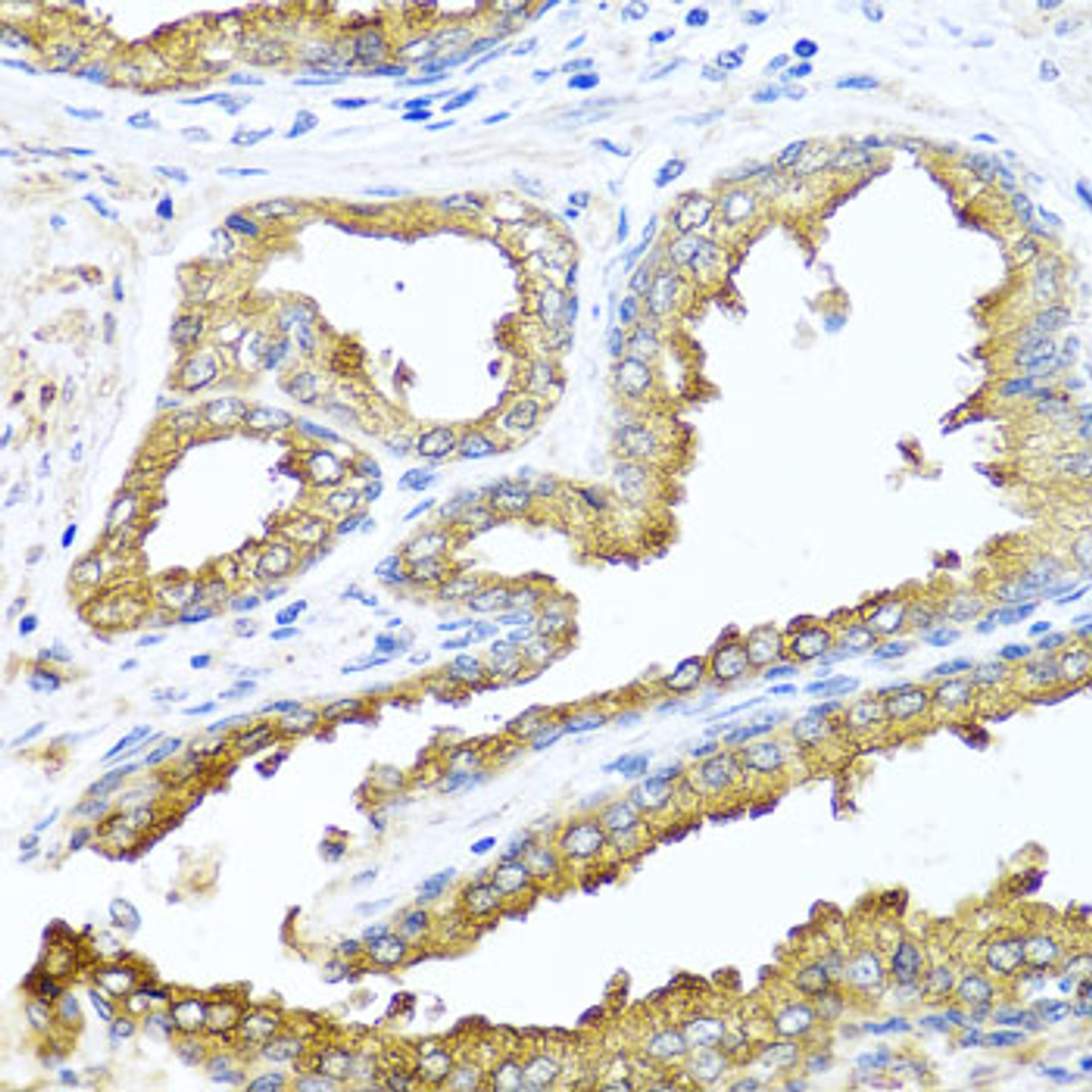 Immunohistochemistry of paraffin-embedded human prostate using NCK2 antibody (23-155) at dilution of 1:100 (40x lens) .