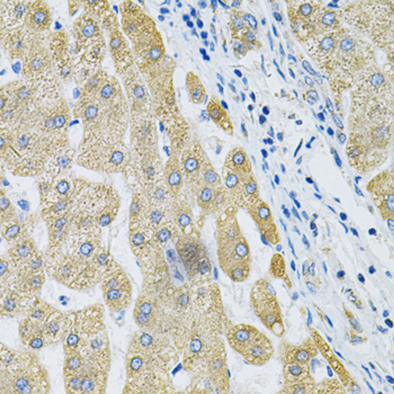 Immunohistochemistry of paraffin-embedded human liver cancer using ALG2 Antibody (23-221) at dilution of 1:100 (40x lens) .