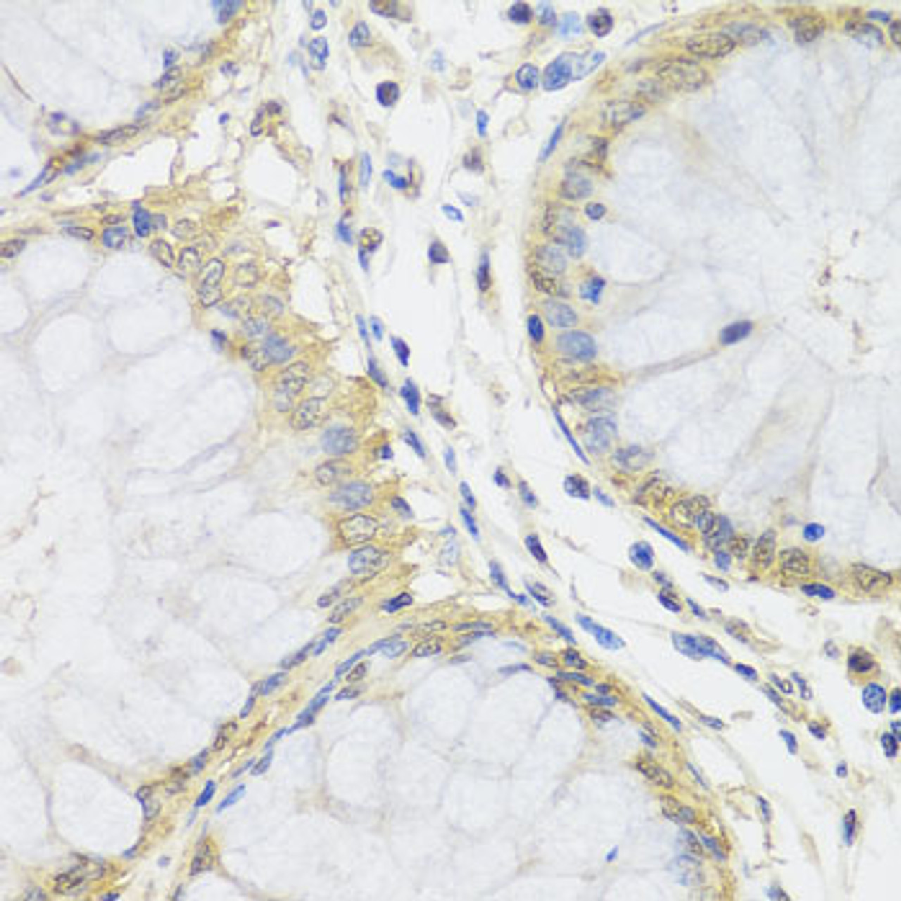 Immunohistochemistry of paraffin-embedded human colon using MTX1 antibody (23-275) at dilution of 1:100 (40x lens) .