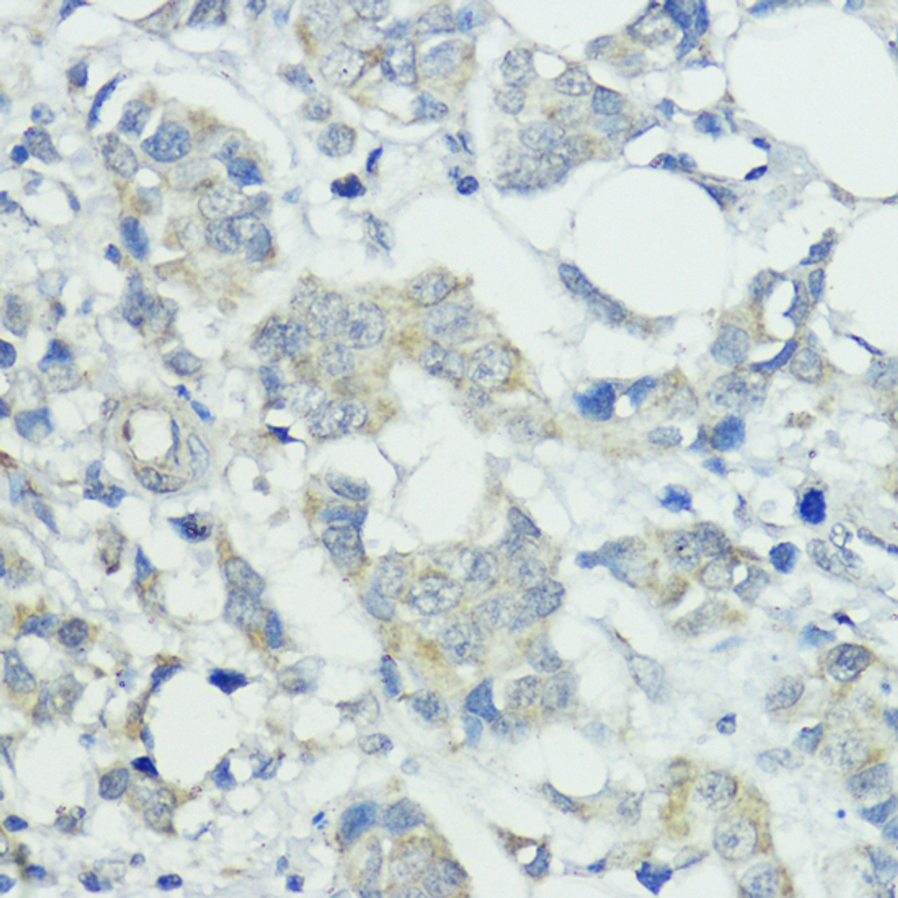 Immunohistochemistry of paraffin-embedded human mammary cancer using SOCS5 antibody (23-305) at dilution of 1:100 (40x lens) .