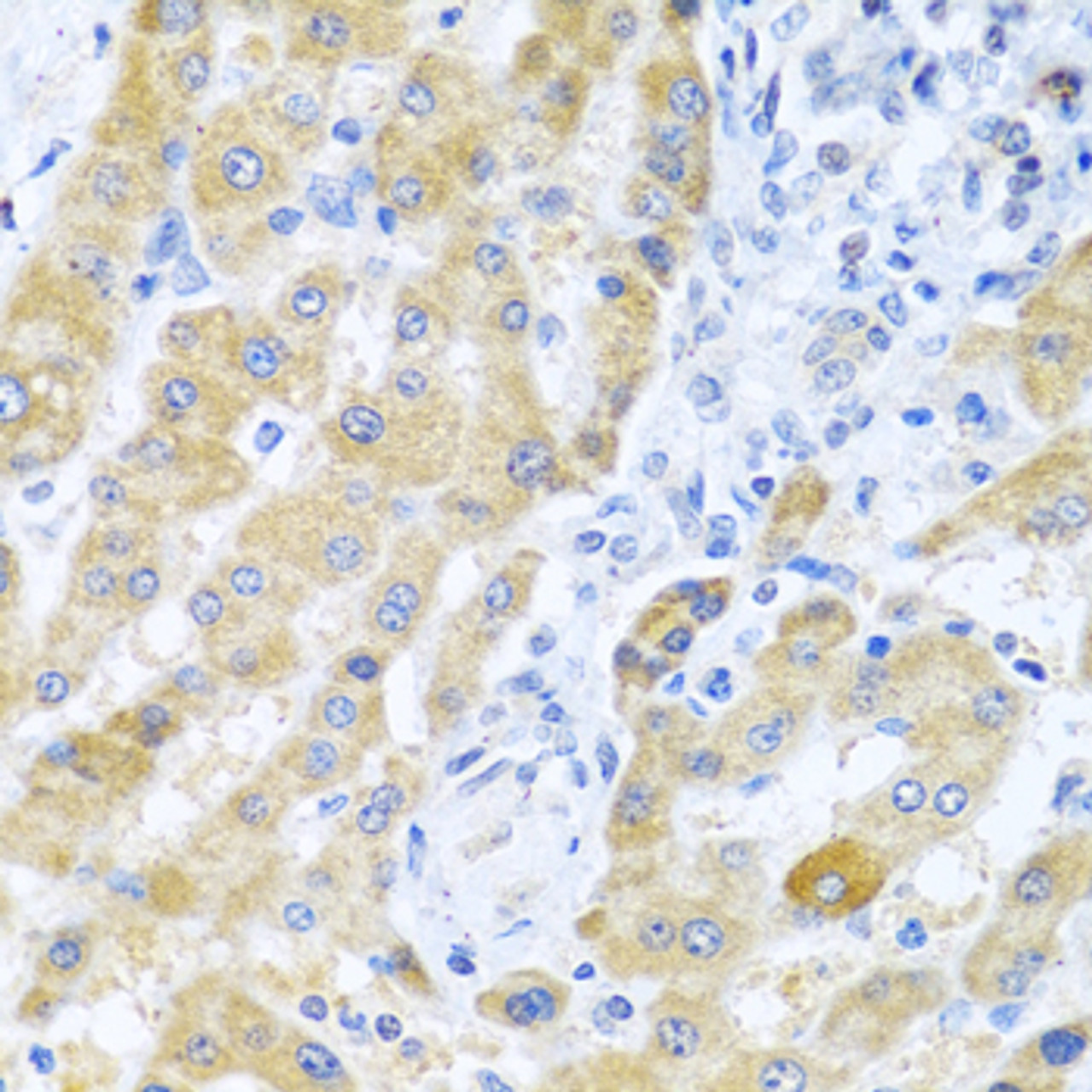 Immunohistochemistry of paraffin-embedded human liver cancer using Gm13125 antibody (23-397) at dilution of 1:100 (40x lens) .