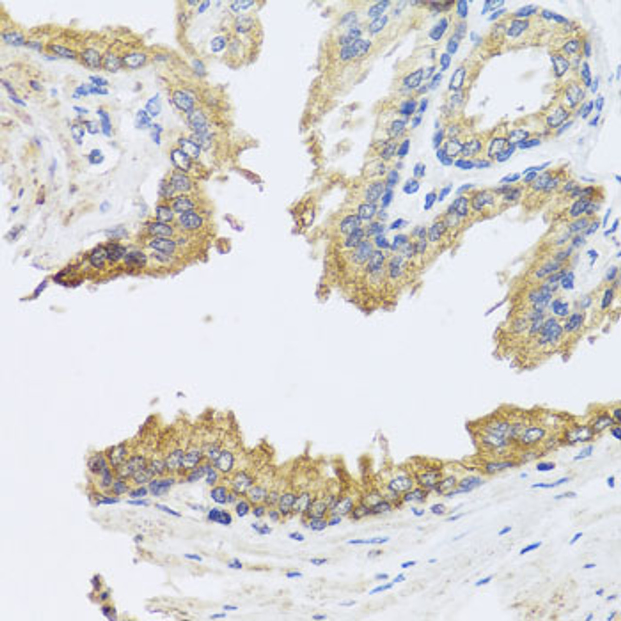 Immunohistochemistry of paraffin-embedded human prostate using ARL6 antibody (23-485) at dilution of 1:100 (40x lens) .