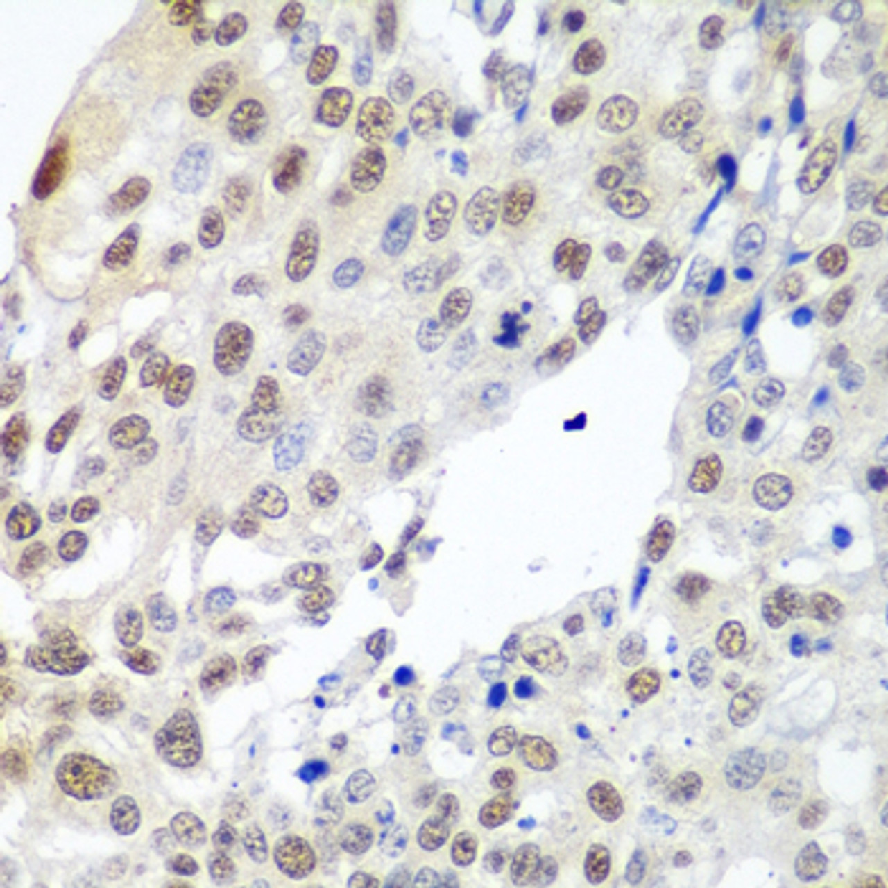 Immunohistochemistry of paraffin-embedded human lung cancer using PTTG1 antibody (23-500) at dilution of 1:100 (40x lens) .