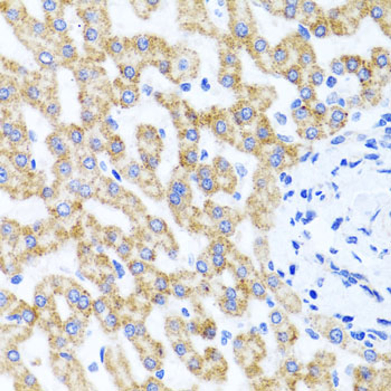 Immunohistochemistry of paraffin-embedded human liver damage using RIPK4 antibody (23-623) at dilution of 1:100 (40x lens) .