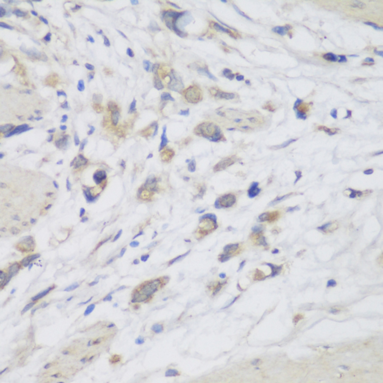 Immunohistochemistry of paraffin-embedded human lung cancer using CEMIP antibody (23-676) at dilution of 1:150 (40x lens) .