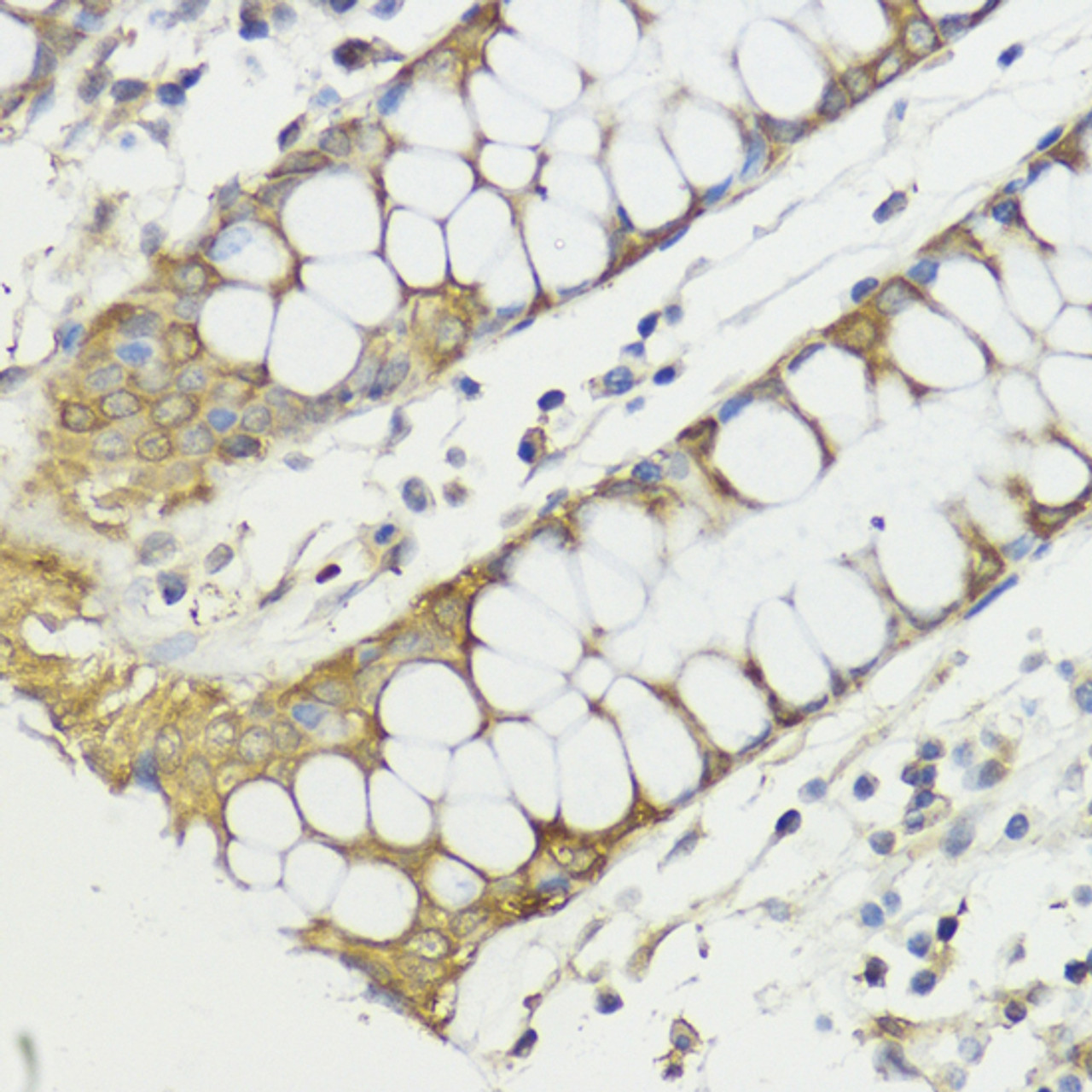 Immunohistochemistry of paraffin-embedded human colon using HACE1 antibody (23-886) at dilution of 1:100 (40x lens) .