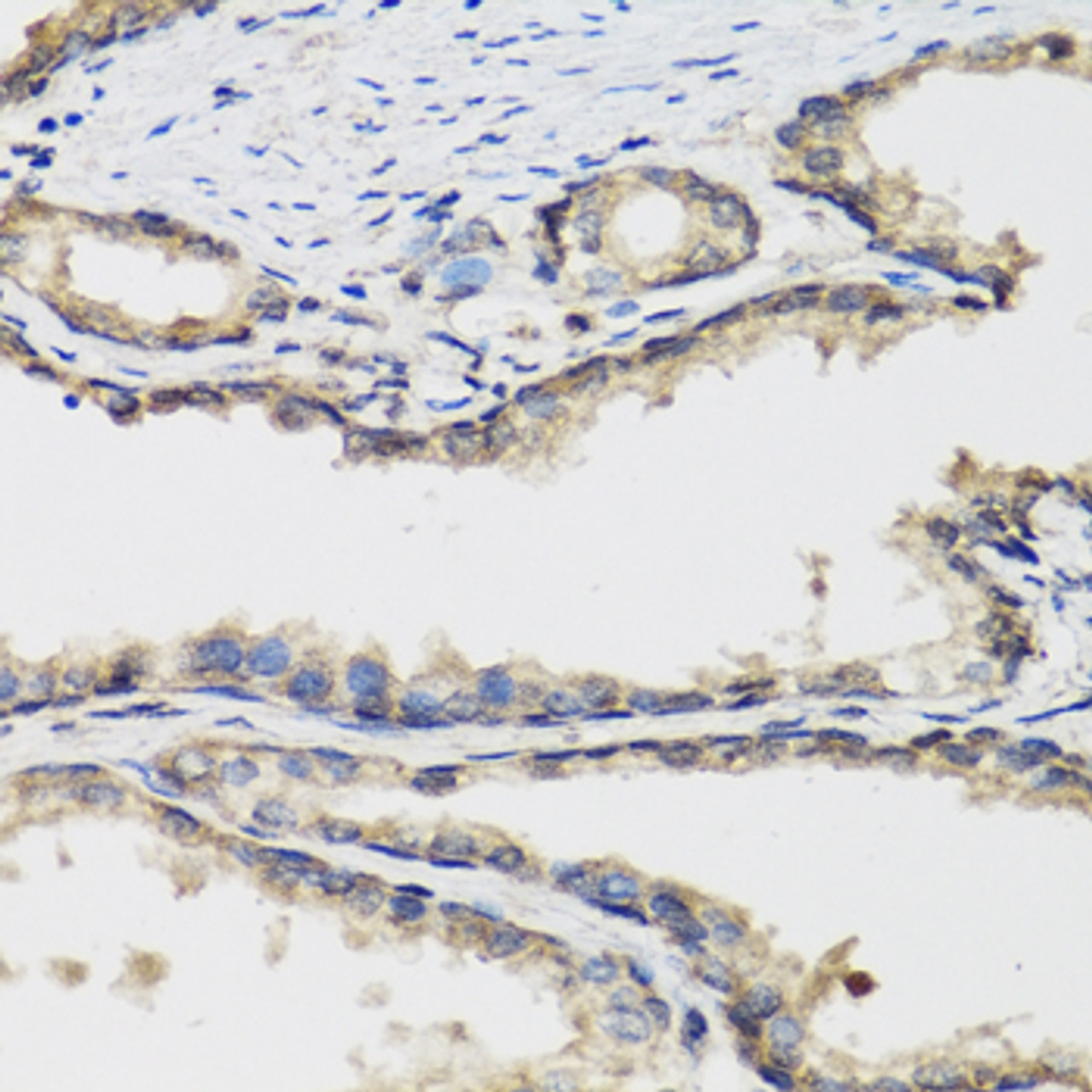 Immunohistochemistry of paraffin-embedded human prostate using PLA2G7 antibody (23-906) at dilution of 1:100 (40x lens) .