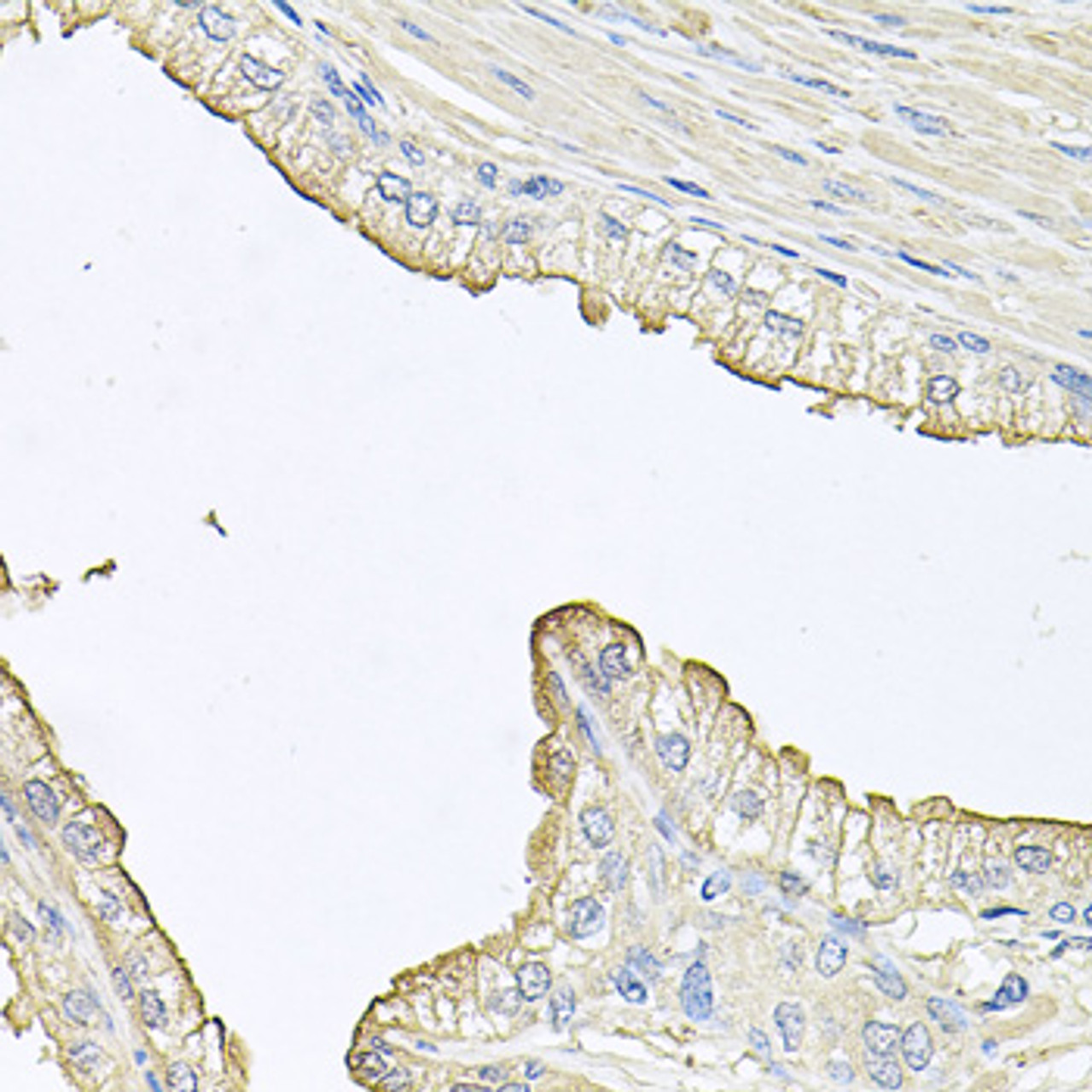 Immunohistochemistry of paraffin-embedded human prostate using FABP12 antibody (23-963) at dilution of 1:100 (40x lens) .