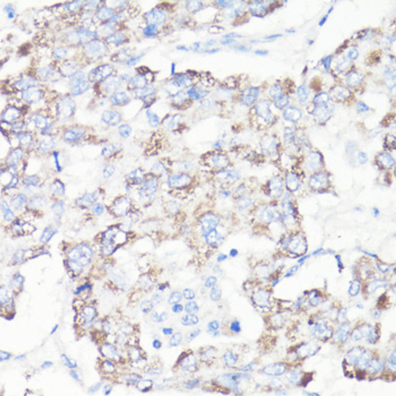 Immunohistochemistry of paraffin-embedded human liver cancer using VDAC1 / Porin antibody (13-960) at dilution of 1:100 (40x lens) .