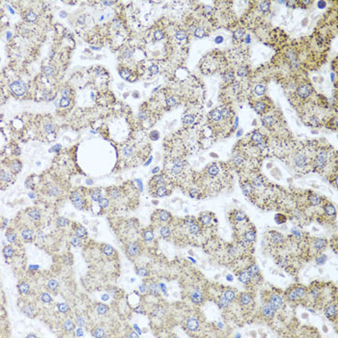 Immunohistochemistry of paraffin-embedded human liver damage using TSG101 antibody (16-799) at dilution of 1:100 (40x lens) .