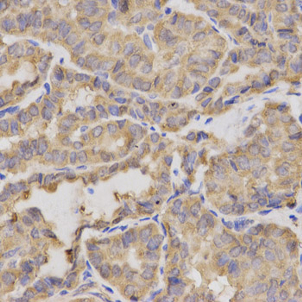 Immunohistochemistry of paraffin-embedded human thyroid cancer using XRCC2 antibody (18-186) at dilution of 1:200 (40x lens) .